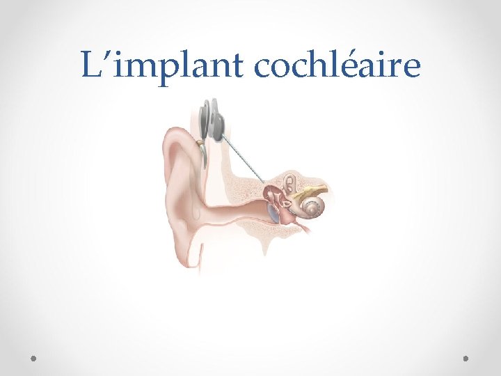 L’implant cochléaire 