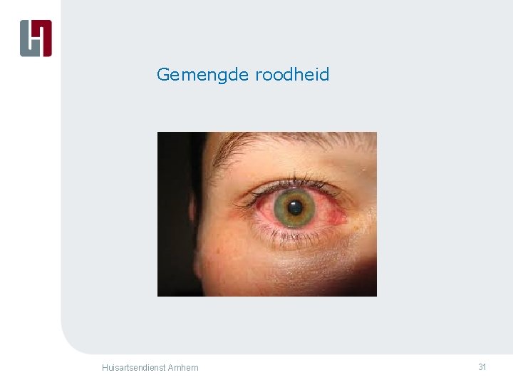 Gemengde roodheid Huisartsendienst Arnhem 31 