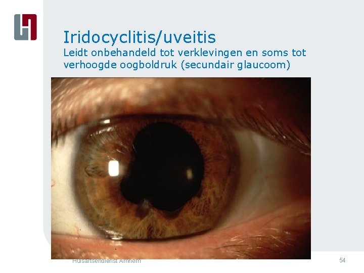 Iridocyclitis/uveitis Leidt onbehandeld tot verklevingen en soms tot verhoogde oogboldruk (secundair glaucoom) Huisartsendienst Arnhem
