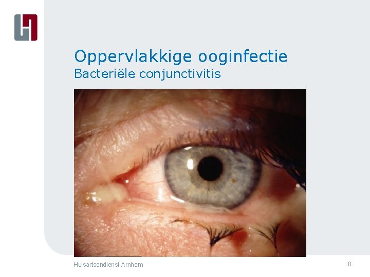 Oppervlakkige ooginfectie Bacteriële conjunctivitis Huisartsendienst Arnhem 8 