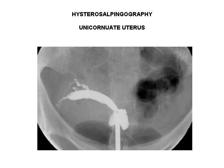 HYSTEROSALPINGOGRAPHY UNICORNUATE UTERUS HYSTEROSALPINGOGRAPHY UNICORNUATE UTERUS