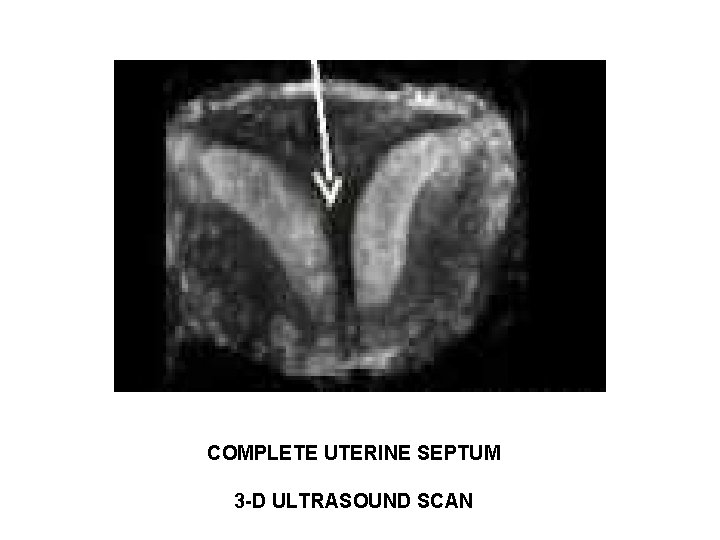 COMPLETE UTERINE SEPTUM 3 -D ULTRASOUND SCAN COMPLETE UTERINE SEPTUM 3 -D ULTRASOUND SCAN
