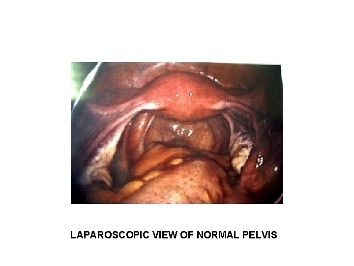 LAPAROSCOPIC VIEW OF NORMAL PELVIS LAPAROSCOPIC VIEW OF NORMAL PELVIS