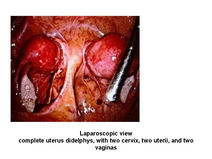 Laparoscopic view complete uterus didelphys, with two cervix, two uterii, and two vaginas Laparoscopic view complete uterus didelphys, with two cervix, two uterii, and two vaginas