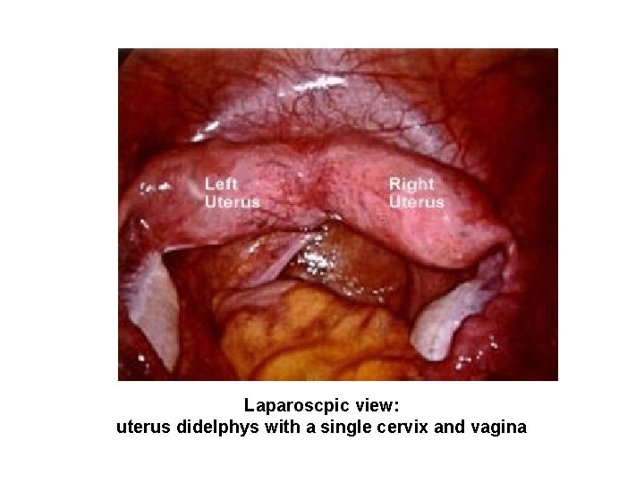 Laparoscpic view: uterus didelphys with a single cervix and vagina Laparoscpic view: uterus didelphys with a single cervix and vagina