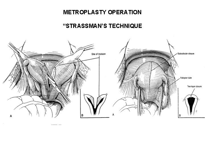 METROPLASTY OPERATION “STRASSMAN’S TECHNIQUE METROPLASTY OPERATION “STRASSMAN’S TECHNIQUE