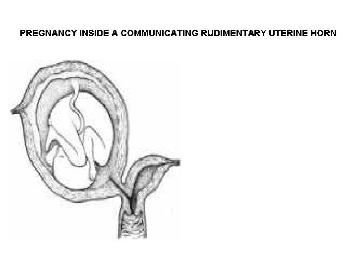 PREGNANCY INSIDE A COMMUNICATING RUDIMENTARY UTERINE HORN PREGNANCY INSIDE A COMMUNICATING RUDIMENTARY UTERINE HORN