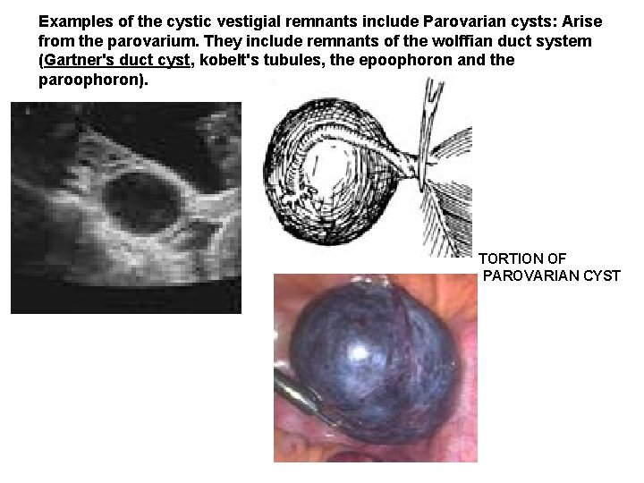 Examples of the cystic vestigial remnants include Parovarian cysts: Arise from the parovarium. They Examples of the cystic vestigial remnants include Parovarian cysts: Arise from the parovarium. They