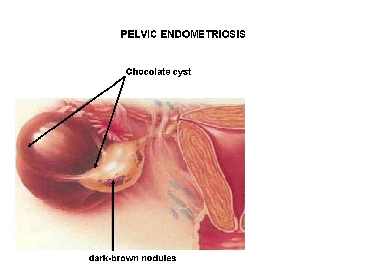 PELVIC ENDOMETRIOSIS Chocolate cyst dark-brown nodules PELVIC ENDOMETRIOSIS Chocolate cyst dark-brown nodules