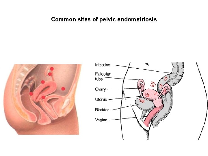 Common sites of pelvic endometriosis Common sites of pelvic endometriosis
