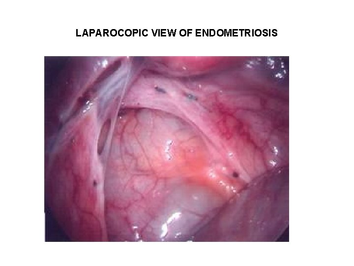 LAPAROCOPIC VIEW OF ENDOMETRIOSIS LAPAROCOPIC VIEW OF ENDOMETRIOSIS