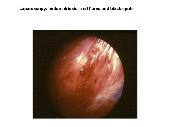 Laparoscopy: endometriosis - red flares and black spots Laparoscopy: endometriosis - red flares and black spots