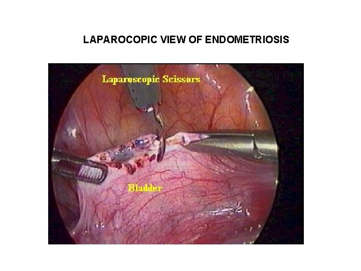 LAPAROCOPIC VIEW OF ENDOMETRIOSIS LAPAROCOPIC VIEW OF ENDOMETRIOSIS