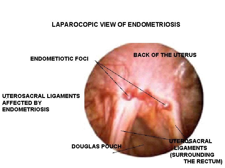LAPAROCOPIC VIEW OF ENDOMETRIOSIS ENDOMETIOTIC FOCI BACK OF THE UTERUS UTEROSACRAL LIGAMENTS. AFFECTED BY LAPAROCOPIC VIEW OF ENDOMETRIOSIS ENDOMETIOTIC FOCI BACK OF THE UTERUS UTEROSACRAL LIGAMENTS. AFFECTED BY