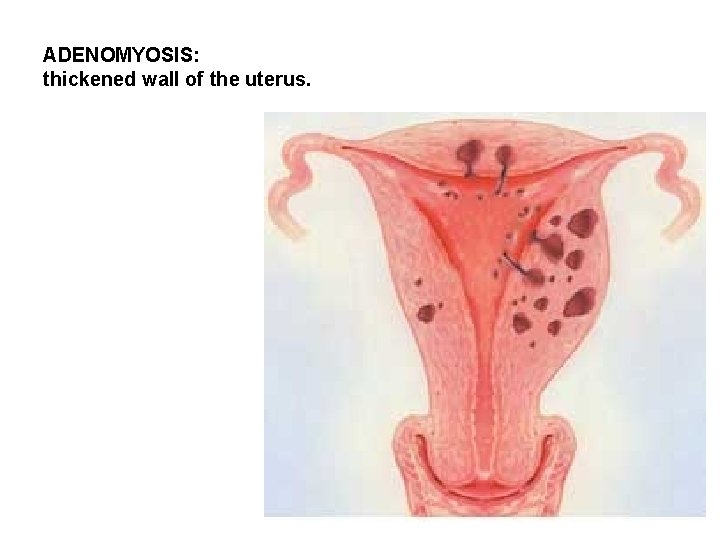 ADENOMYOSIS: thickened wall of the uterus. ADENOMYOSIS: thickened wall of the uterus.