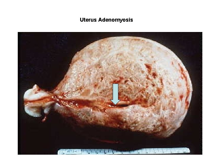 Uterus Adenomyosis Uterus Adenomyosis