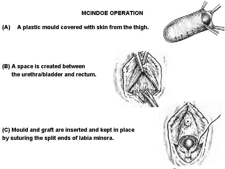 MCINDOE OPERATION (A) A plastic mould covered with skin from the thigh. (B) A MCINDOE OPERATION (A) A plastic mould covered with skin from the thigh. (B) A