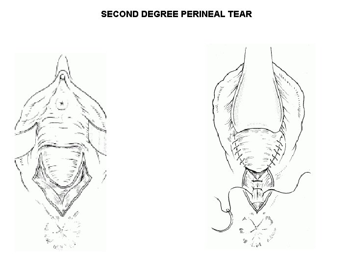 SECOND DEGREE PERINEAL TEAR SECOND DEGREE PERINEAL TEAR