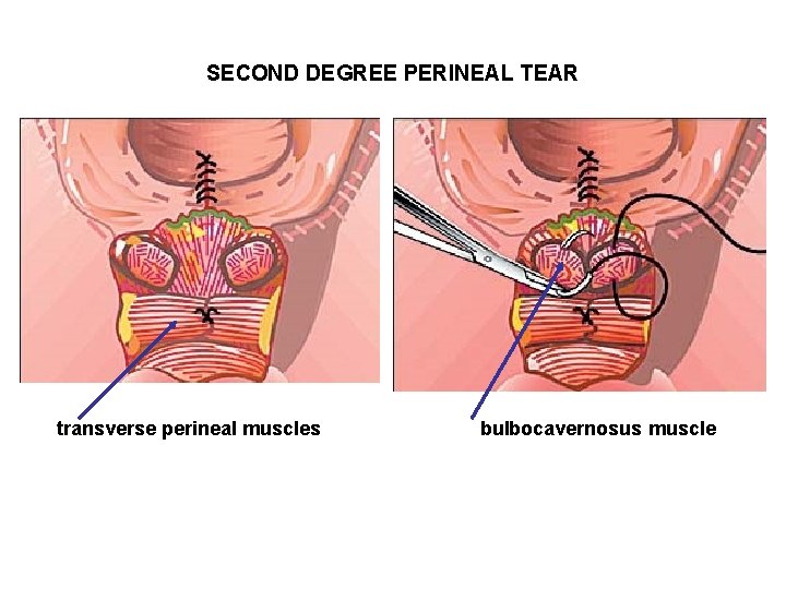 SECOND DEGREE PERINEAL TEAR transverse perineal muscles bulbocavernosus muscle SECOND DEGREE PERINEAL TEAR transverse perineal muscles bulbocavernosus muscle