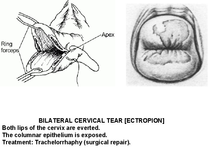 BILATERAL CERVICAL TEAR [ECTROPION] Both lips of the cervix are everted. The columnar epithelium