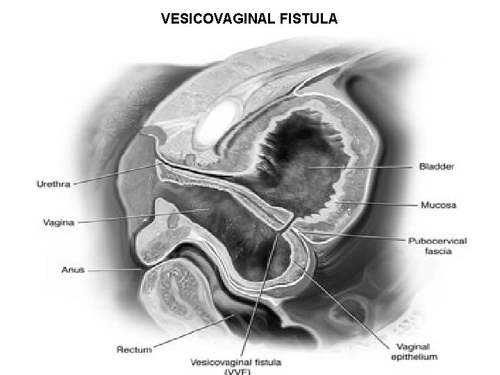 VESICOVAGINAL FISTULA VESICOVAGINAL FISTULA
