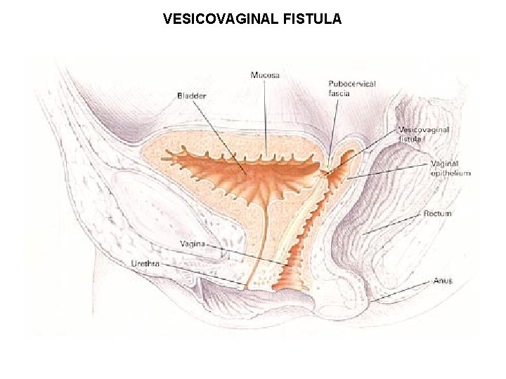VESICOVAGINAL FISTULA VESICOVAGINAL FISTULA