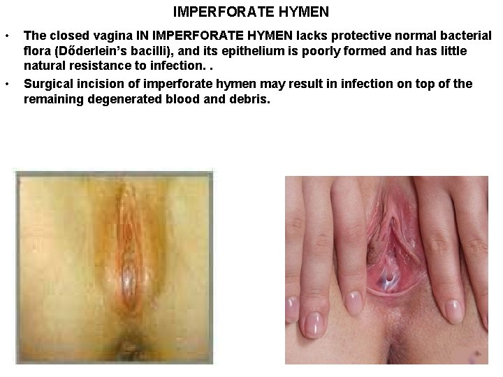 IMPERFORATE HYMEN • • The closed vagina IN IMPERFORATE HYMEN lacks protective normal bacterial IMPERFORATE HYMEN • • The closed vagina IN IMPERFORATE HYMEN lacks protective normal bacterial