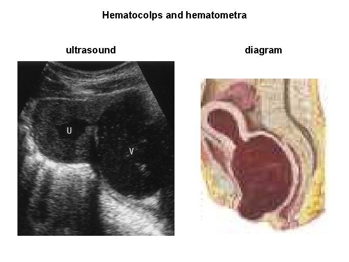 Hematocolps and hematometra ultrasound diagram Hematocolps and hematometra ultrasound diagram