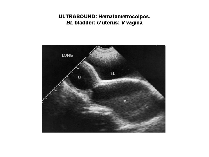 ULTRASOUND: Hematometrocolpos. BL bladder; U uterus; V vagina ULTRASOUND: Hematometrocolpos. BL bladder; U uterus; V vagina