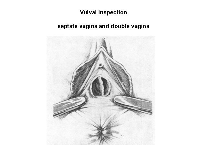 Vulval inspection septate vagina and double vagina Vulval inspection septate vagina and double vagina