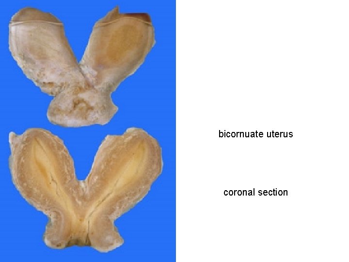 bicornuate uterus coronal section bicornuate uterus coronal section