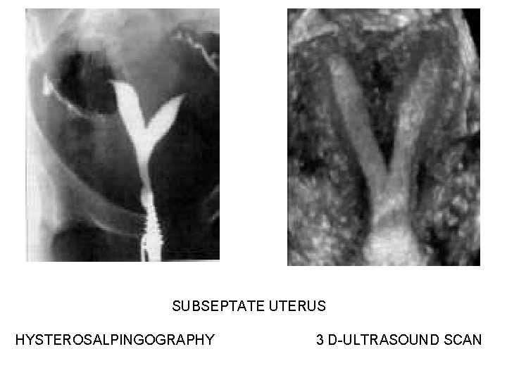 SUBSEPTATE UTERUS HYSTEROSALPINGOGRAPHY 3 D-ULTRASOUND SCAN SUBSEPTATE UTERUS HYSTEROSALPINGOGRAPHY 3 D-ULTRASOUND SCAN