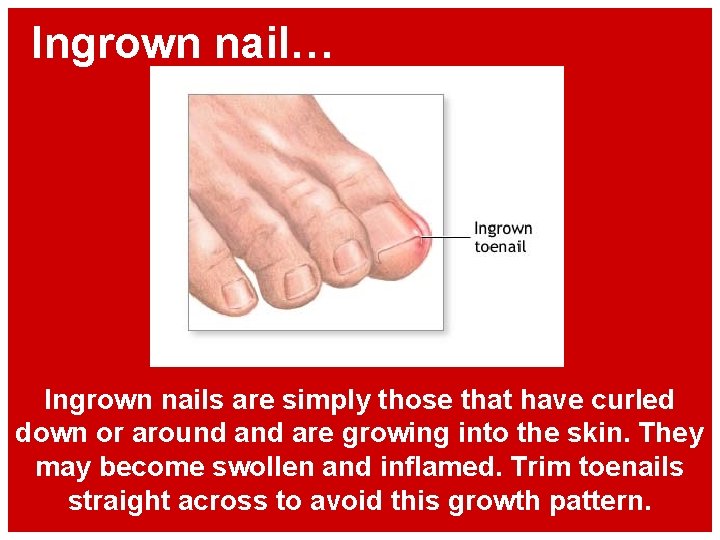 Ingrown nail… Ingrown nails are simply those that have curled down or around are