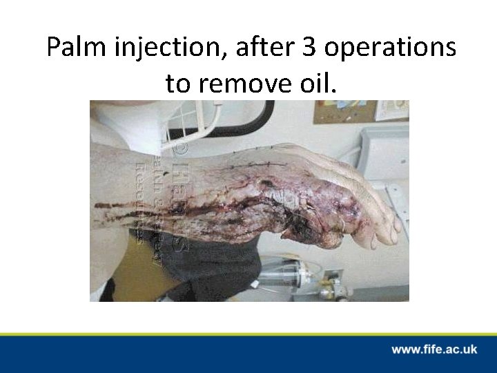 Palm injection, after 3 operations to remove oil. 