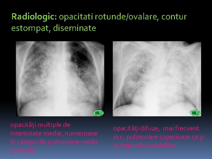 Radiologic: opacitati rotunde/ovalare, contur estompat, diseminate opacităţi multiple de intensitate medie, numeroase în câmpurile