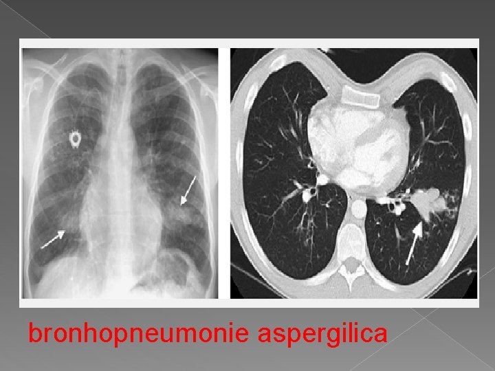 bronhopneumonie aspergilica 