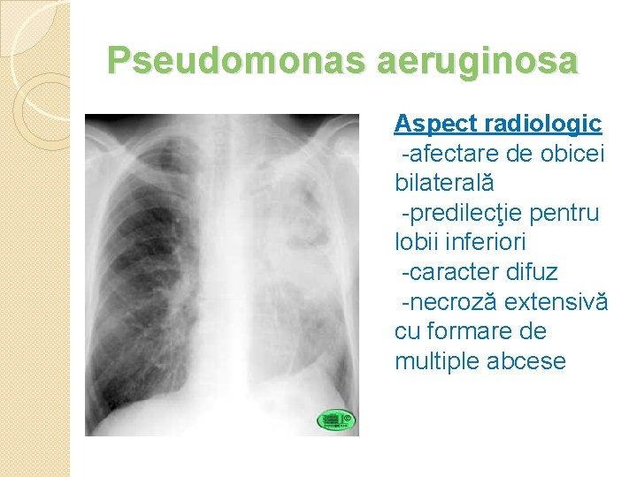 Pseudomonas aeruginosa Aspect radiologic -afectare de obicei bilaterală -predilecţie pentru lobii inferiori -caracter difuz