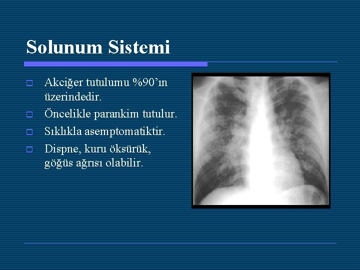 Solunum Sistemi o o Akciğer tutulumu %90’ın üzerindedir. Öncelikle parankim tutulur. Sıklıkla asemptomatiktir. Dispne,