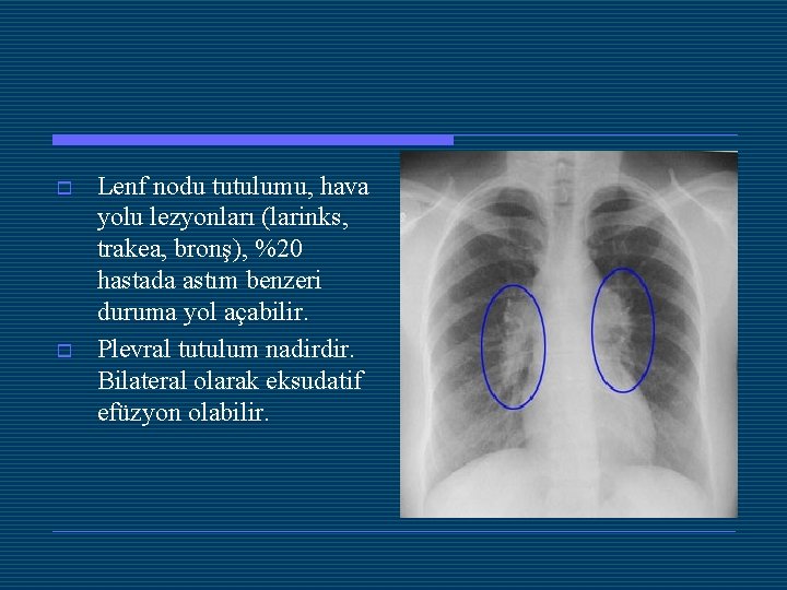 o o Lenf nodu tutulumu, hava yolu lezyonları (larinks, trakea, bronş), %20 hastada astım