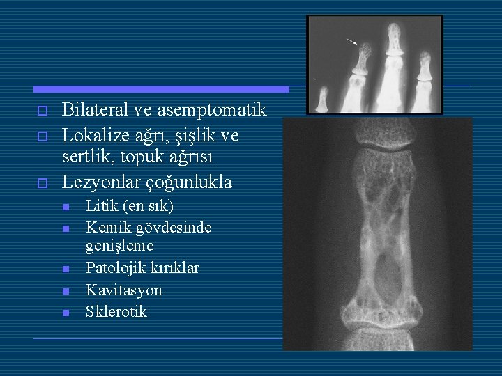 o o o Bilateral ve asemptomatik Lokalize ağrı, şişlik ve sertlik, topuk ağrısı Lezyonlar