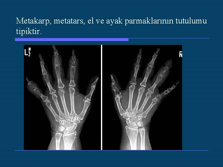 Metakarp, metatars, el ve ayak parmaklarının tutulumu tipiktir. 