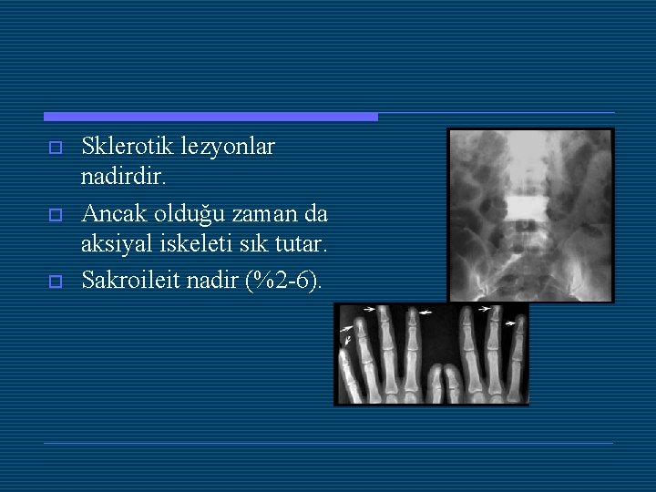 o o o Sklerotik lezyonlar nadirdir. Ancak olduğu zaman da aksiyal iskeleti sık tutar.