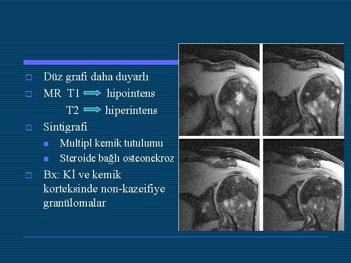 o o o Düz grafi daha duyarlı MR T 1 hipointens T 2 hiperintens