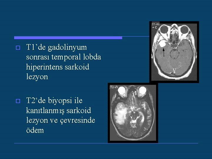 o T 1’de gadolinyum sonrası temporal lobda hiperintens sarkoid lezyon o T 2‘de biyopsi