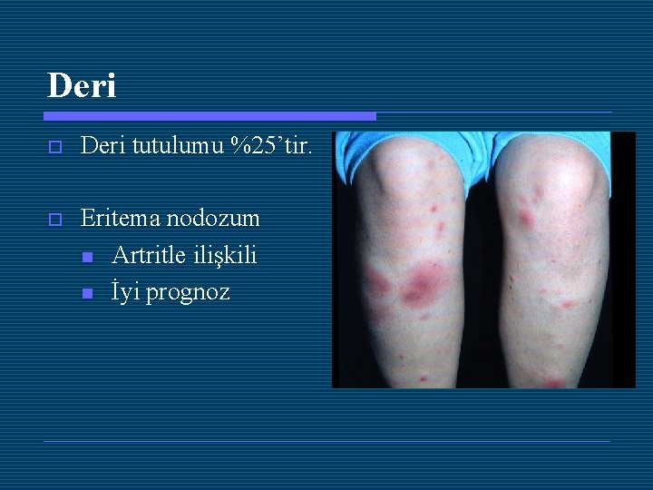 Deri o Deri tutulumu %25’tir. o Eritema nodozum n Artritle ilişkili n İyi prognoz