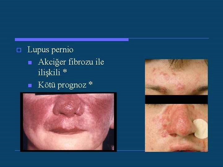 o Lupus pernio n Akciğer fibrozu ile ilişkili * n Kötü prognoz * 