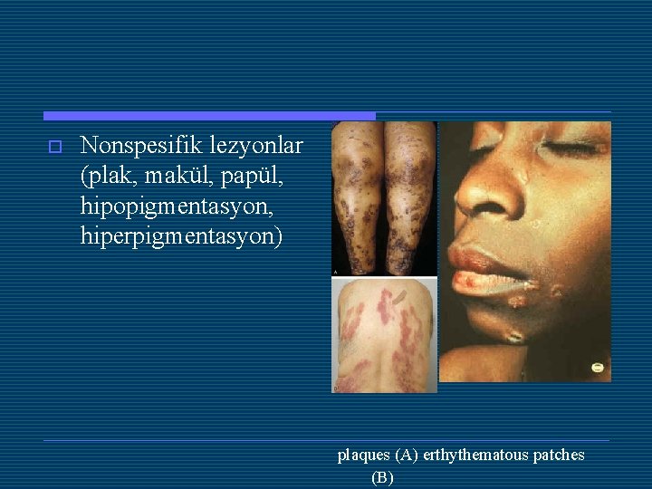 o Nonspesifik lezyonlar (plak, makül, papül, hipopigmentasyon, hiperpigmentasyon) plaques (A) erthythematous patches (B) 