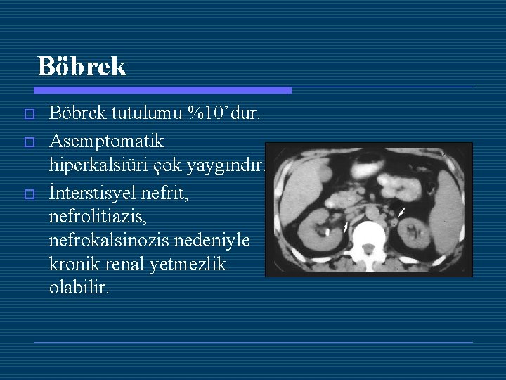 Böbrek o o o Böbrek tutulumu %10’dur. Asemptomatik hiperkalsiüri çok yaygındır. İnterstisyel nefrit, nefrolitiazis,