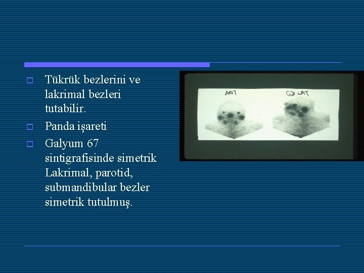 o o o Tükrük bezlerini ve lakrimal bezleri tutabilir. Panda işareti Galyum 67 sintigrafisinde