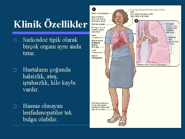 Klinik Özellikler o Sarkoidoz tipik olarak birçok organı aynı anda tutar. o Hastaların çoğunda